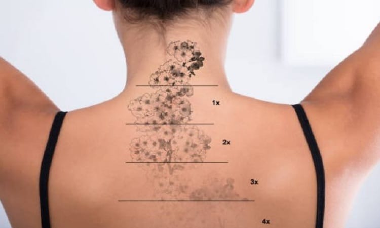How Should I Care For My Skin After Laser Tattoo Removal