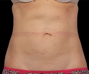 After CoolSculpting Vancouver