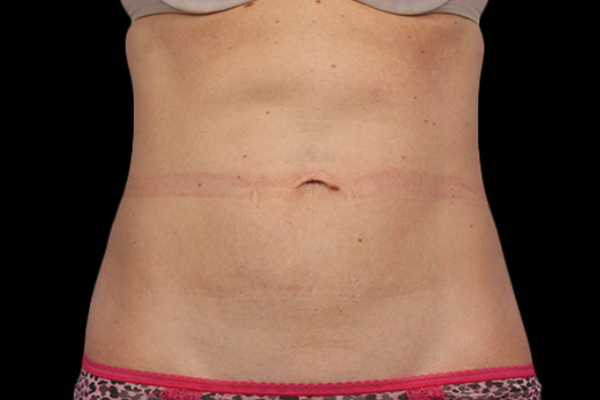 After CoolSculpting Vancouver