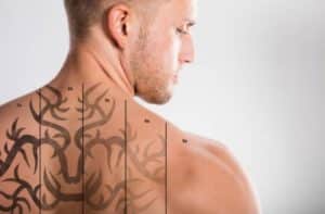Laser Tattoo Removal Vancouver