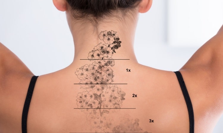 Laser Tattoo Removal Yaletown