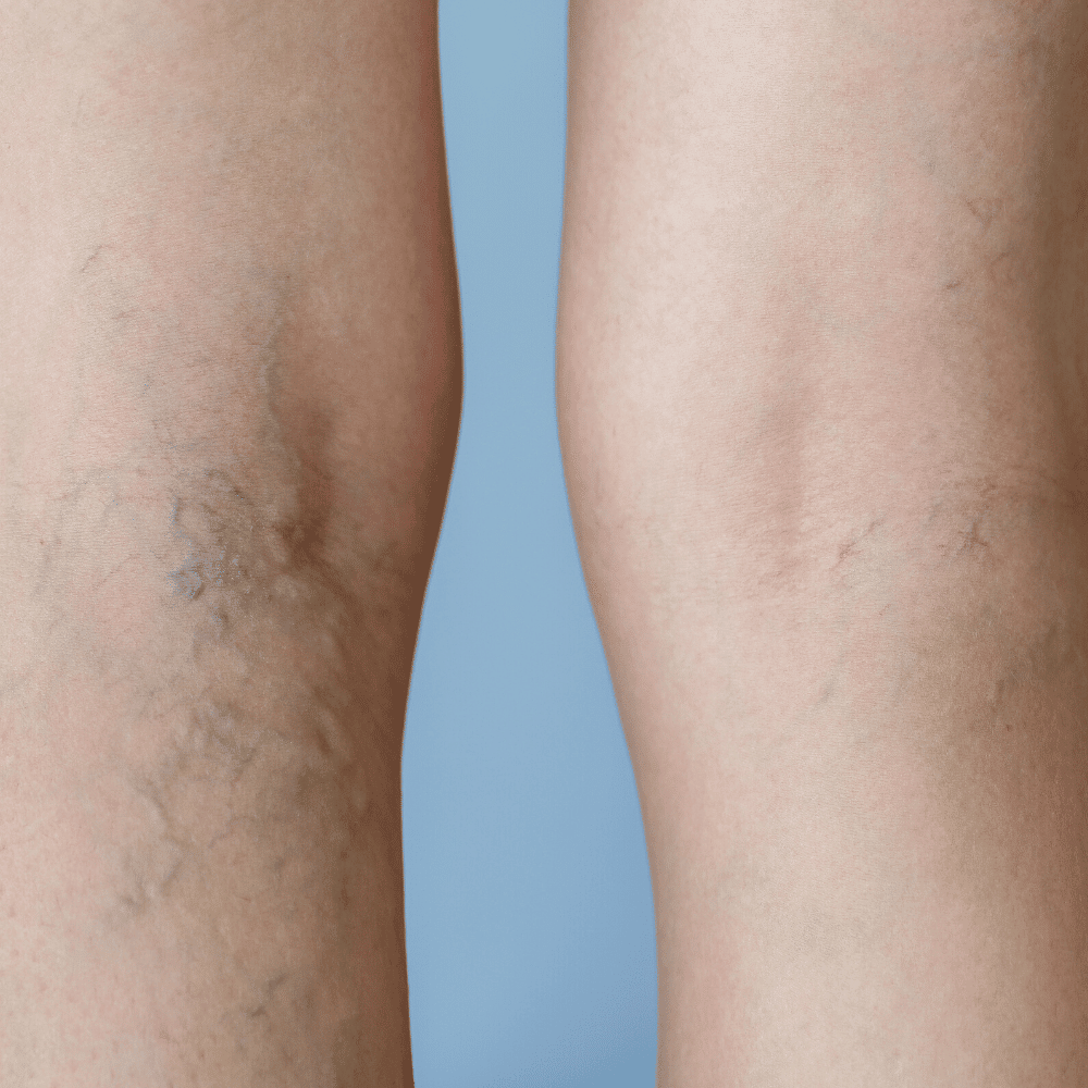 Redness and Facial Veins treatment at Yaletown Laser Centre