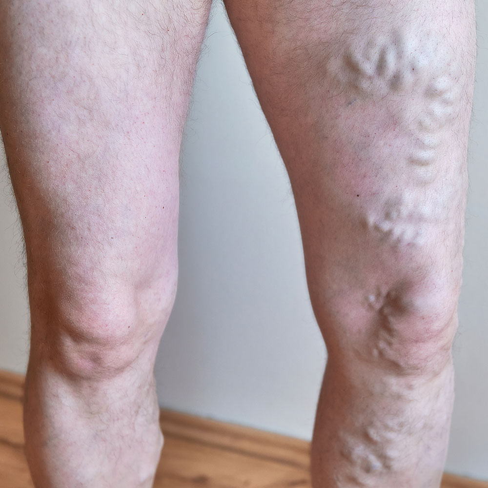 Redness and Facial Veins treatment for Men at Yaletown Laser Centre