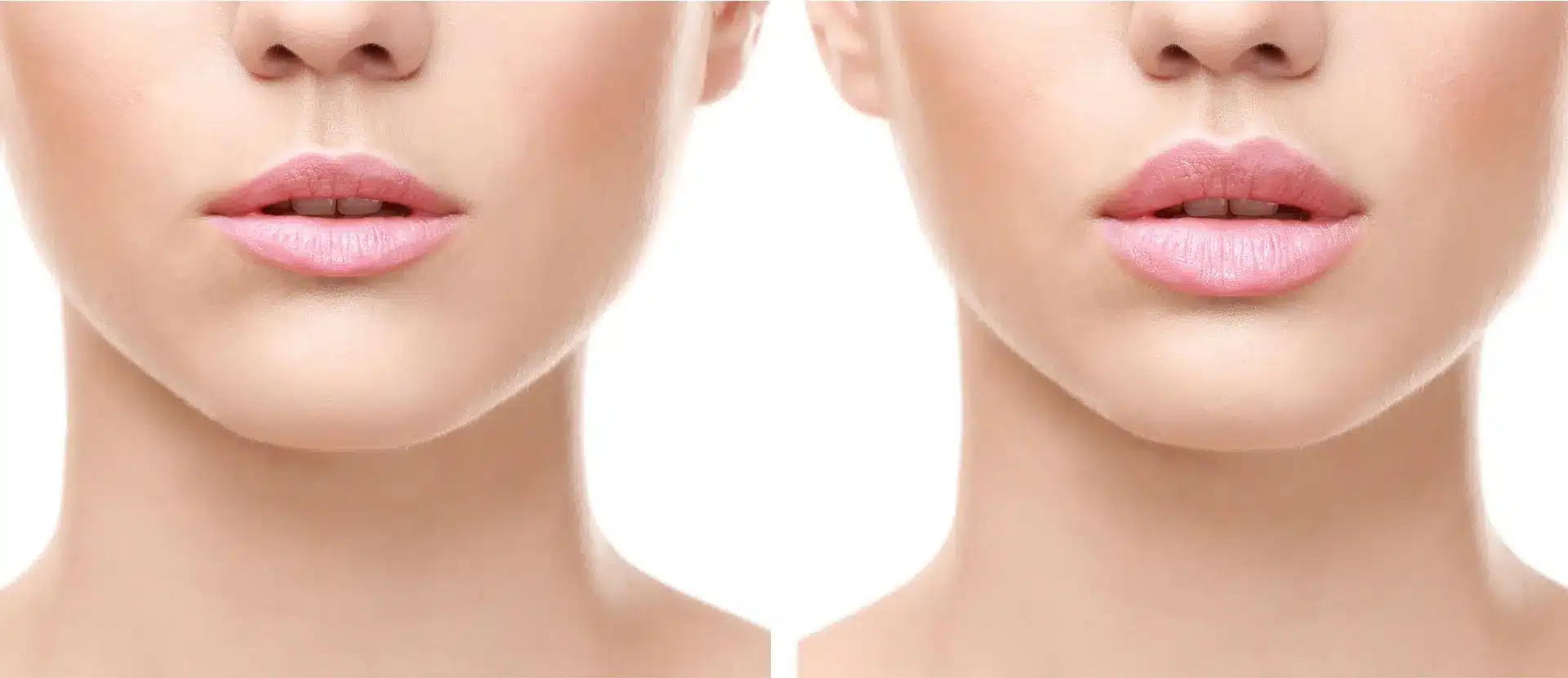 before and after subtle lip enhancements showing natural lip volume improvement without an overdone look
