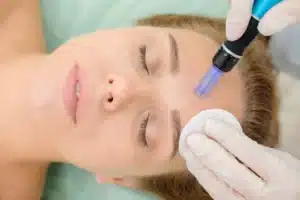 Patient receiving microneedling treatment on the forehead at a Vancouver medical aesthetics clinic to improve skin texture, fine lines, and collagen production.