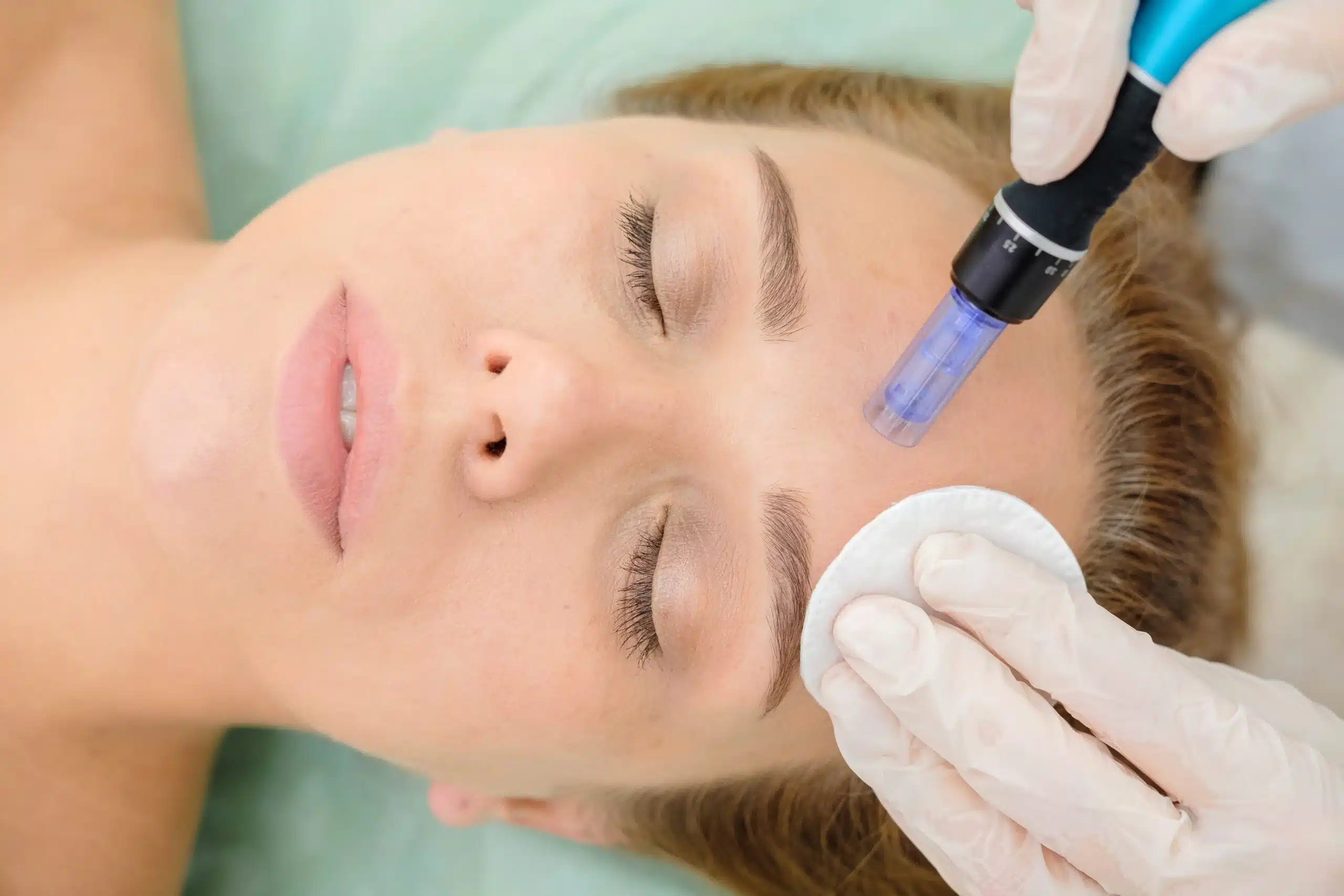 Patient receiving microneedling treatment on the forehead at a Vancouver medical aesthetics clinic to improve skin texture, fine lines, and collagen production.