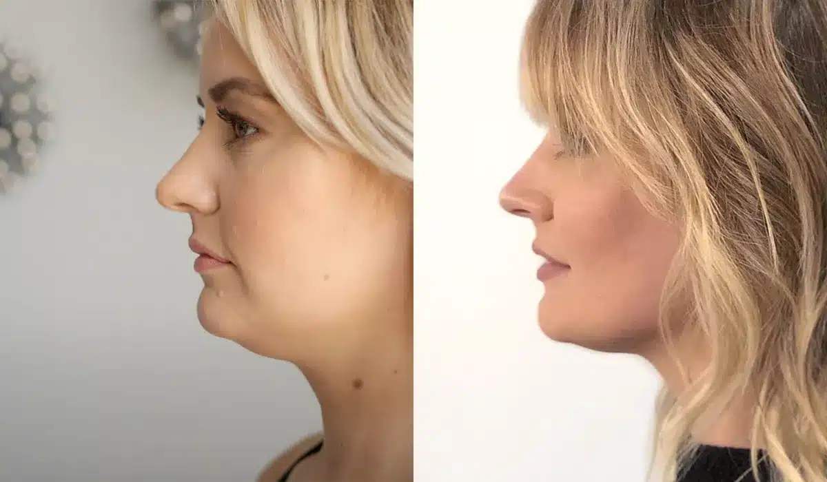 Before and after comparison showing CoolSculpting results for double chin reduction with improved jawline definition and reduced submental fat.