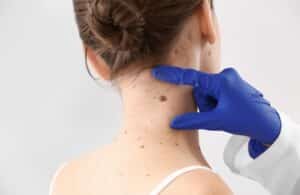 Dermatologist examining a raised mole on the back of a woman's neck.